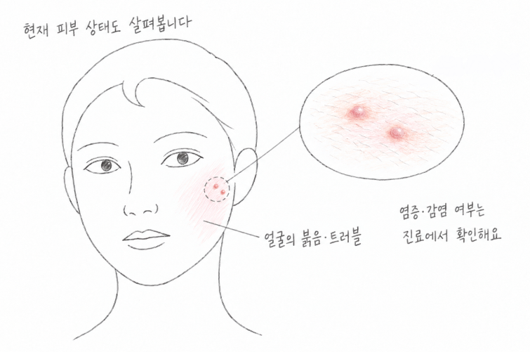 얼굴의 붉음과 트러블을 표시하고 국소 피부 표면을 확대해, 염증·감염 여부는 진료에서 확인한다고 설명한 그림