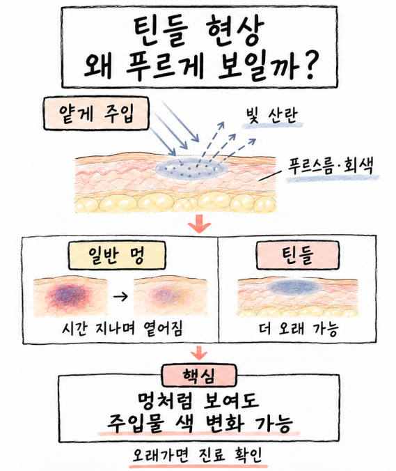 틴들 현상의 발생 원리와 일반적인 멍의 차이를 설명하는 피부 단면도. 피부의 얕은 층에 주입된 물질로 인해 빛이 산란되면서 푸르스름하거나 회색으로 비쳐 보이는 과정을 나타냈다. 일반적인 멍은 시간이 지나며 옅어지지만, 틴들 현상에 의한 색 변화는 더 오래 지속될 수 있다.