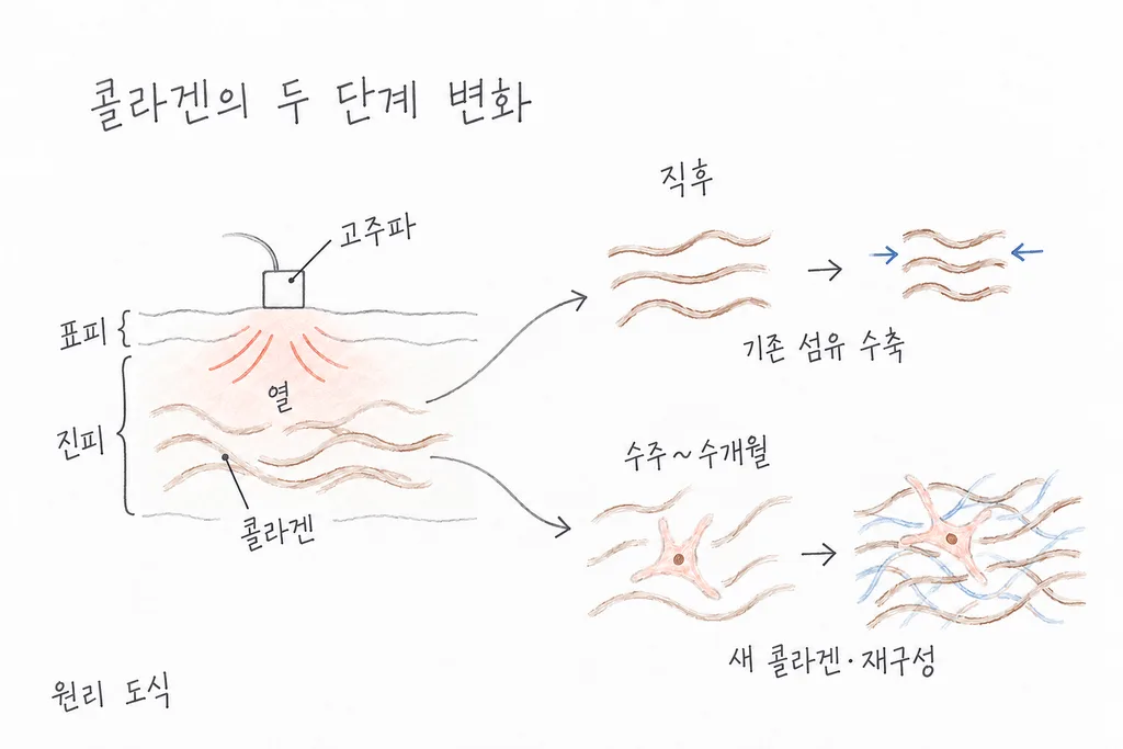 고주파 열에 의한 기존 콜라겐 수축과 새 섬유 형성을 나눈 도식.