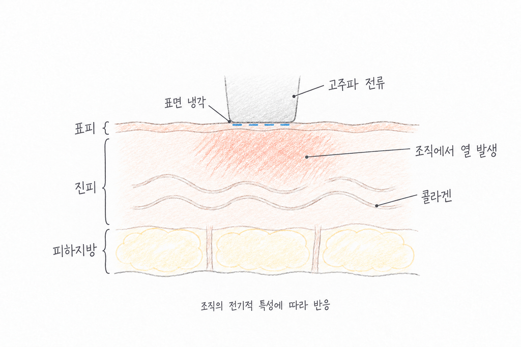 피부에 밀착한 고주파 팁 아래의 열 발생과 표면 냉각을 표시한 피부 단면도.