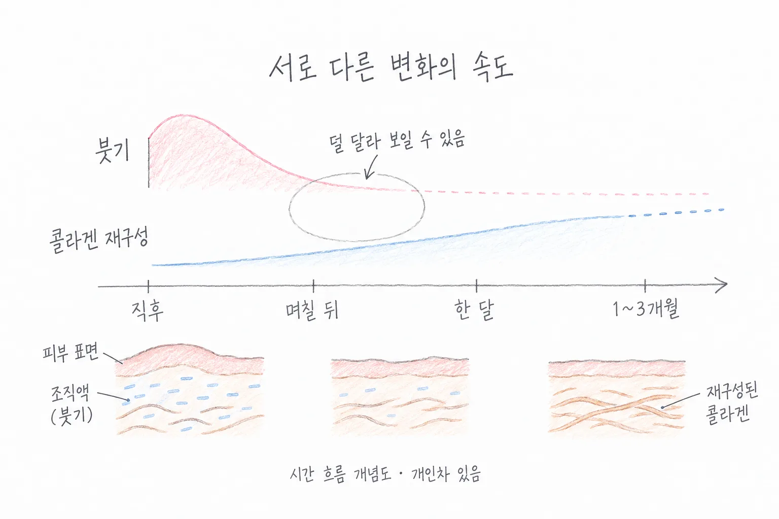 써마지 효과, 1~3개월에 무엇이 달라지고 얼마나 갈까요?