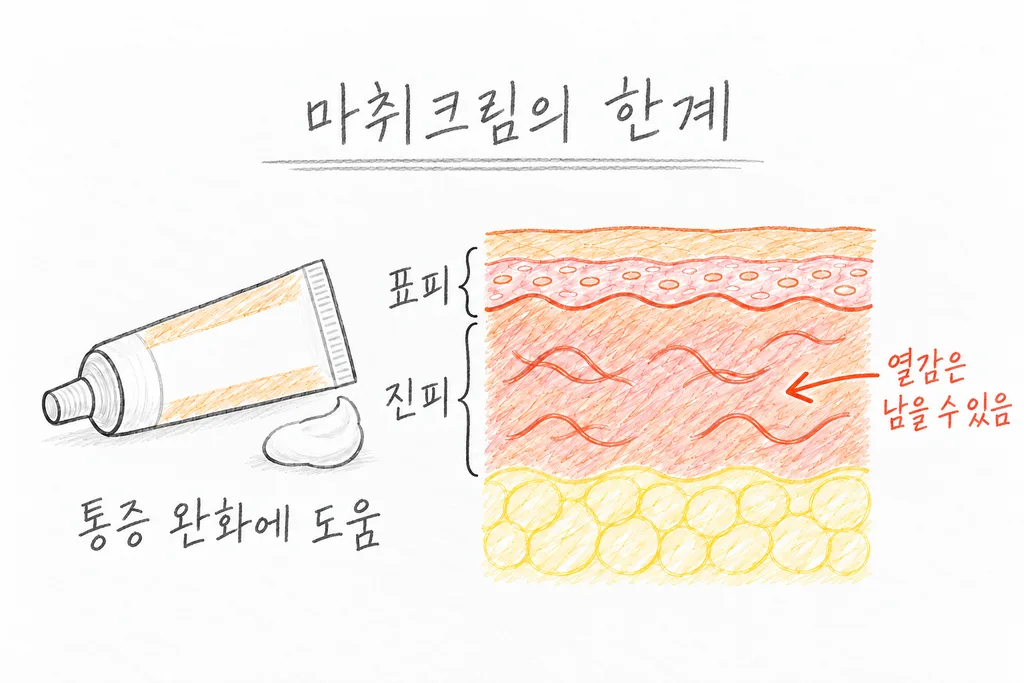 마취크림 튜브와 피부 단면을 나란히 배치해 통증 완화에 도움이 되어도 열감은 남을 수 있음을 설명한 그림.