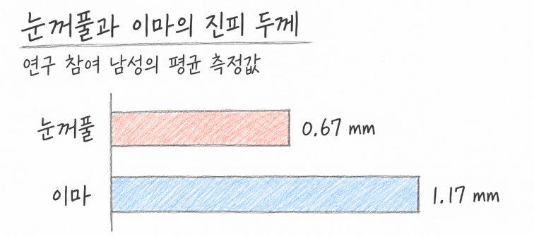 피부 단면 그림에서 진피층에 넣은 액상형 PCL이 주입 라인 주변으로 옅게 퍼져 나가는 모습을 단순화한 개념도