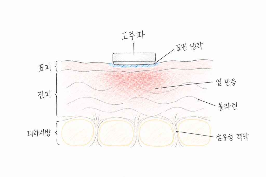 써마지의 표면 냉각과 조직 내부의 열 반응, 콜라겐과 섬유성 격막의 위치를 표시한 피부 단면도.