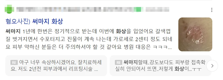 써마지 부작용으로 화상을 입었다는 후기 글이 검색 결과에 나온 화면 캡처